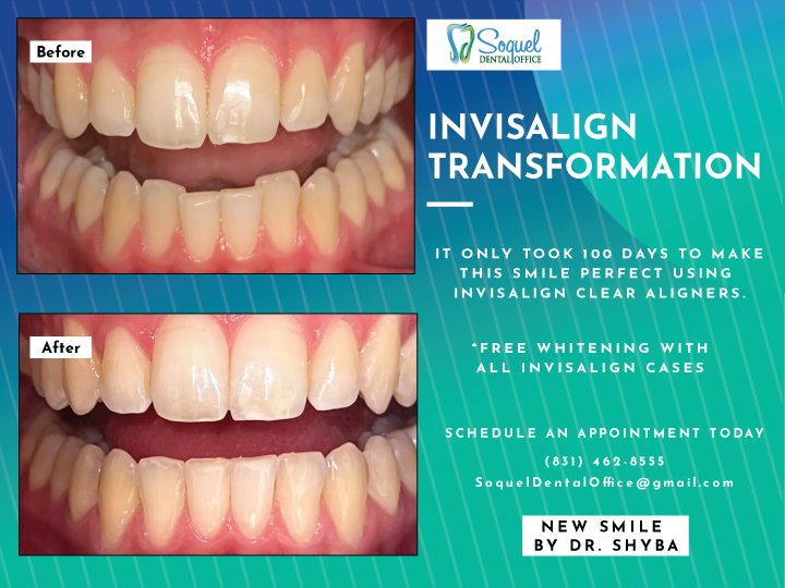 Invisalign smile transformation completed in 100 days with Dr. Justin Shyba, DDS