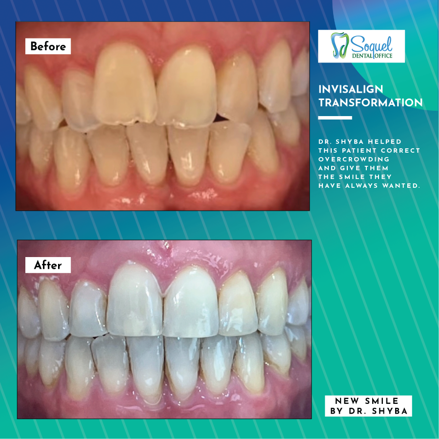 Before and after Invisalign treatment for overcrowded teeth by Dr. Justin Shyba, DDS