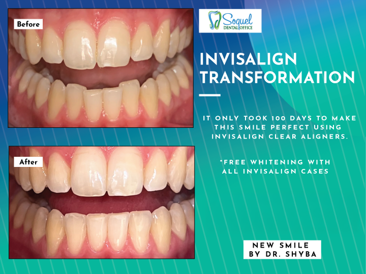 Adult orthodontic before and after results from Soquel Dental Office in Soquel, CA